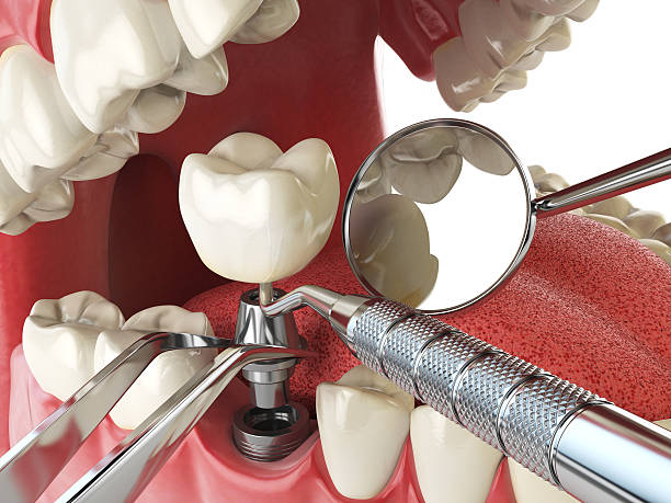 Best Emergency Tooth Extraction in Oxford, PA